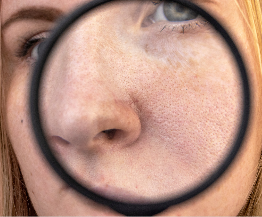 Enlarged Pores | SAM Clinic
